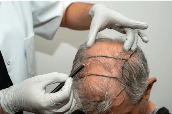 Injerto capilar: La fusión de ciencia y arte en el cuidado del cabello